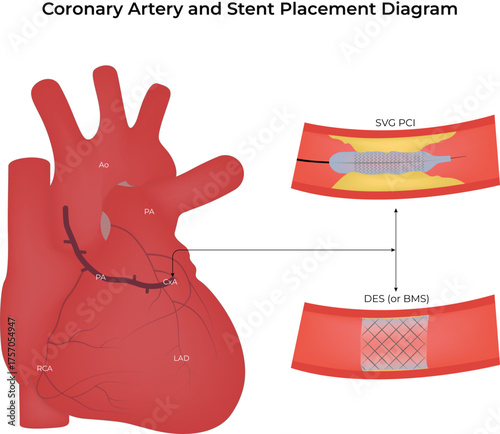 Coronary Artery and Stent Placement Medical Diagram Vector Illustration