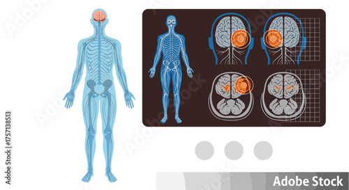 Human Nervous System Illustration Examining Brain Damage Impact with Medical Imaging and Brain Scan Analysis Depicting Neurological Health and Research for Healthcare Presentations and Educational Mat