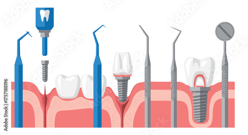 Dental Implant Procedure Surgical Instruments and Tooth Anatomy