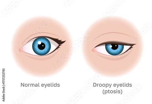 Normal Eyelids vs. Droopy Eyelids: A Simple Ptosis Illustration. Image can be used for beauty and medical content.