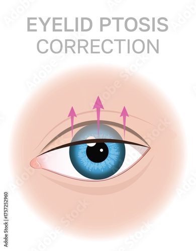 Eyelid Ptosis Correction Concept Illustration.Upper blepharoplasty. Can be used for beauty and medical content.