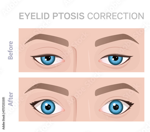Illustration of eyelid ptosis correction showing before and after transformation.Upper blepharoplasty.Perfect for beauty and medical content.