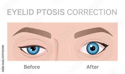 Illustration of eyelid ptosis correction showing before and after transformation.Upper blepharoplasty. Image can be used for beauty and medical content.