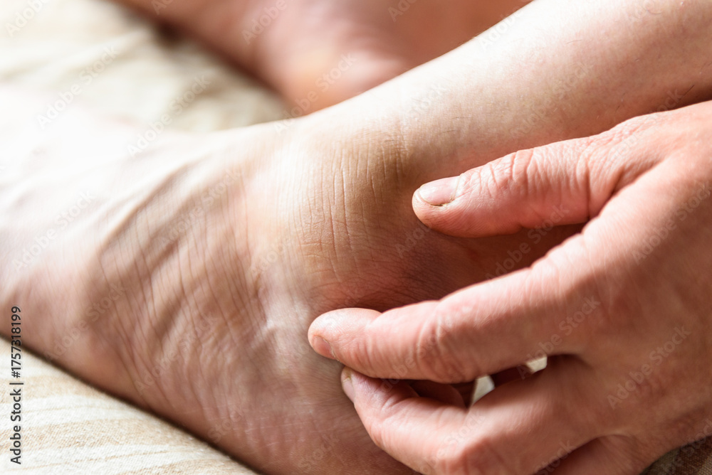 Fototapeta premium Woman's inflamed, swollen foot from a bruise on a bed at home.