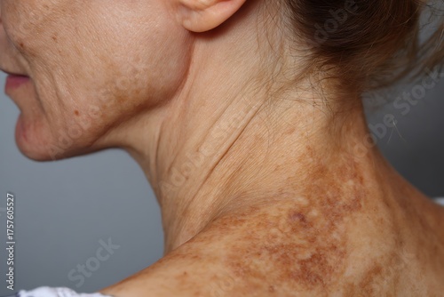 Close-up profile of an older adult's neck and shoulder showing hyperpigmentation, deep wrinkles, and sun damage, highlighting skin aging and dermatology concerns.
