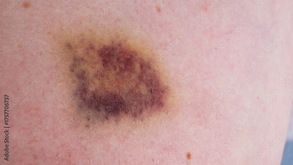 Fototapeta premium The bruise on skin close-up view. Various shades of healing process. Dark purple and yellow bruising colors on white skin. The violence concept. The consequences of injury. High quality 4k footage