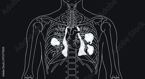 X-ray showing pneumonia with detailed illustration of lungs and heart in human body. Medical diagram illustrates infected lungs and surrounding anatomical structures for educational use.