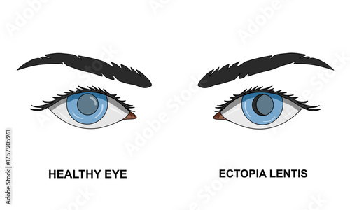 Illustration of Ectopia lentis, torn zonular fibers. Vision disorders, dislocated lens. Vector illustration of eye health, poster for medical, clinical and educational purposes.