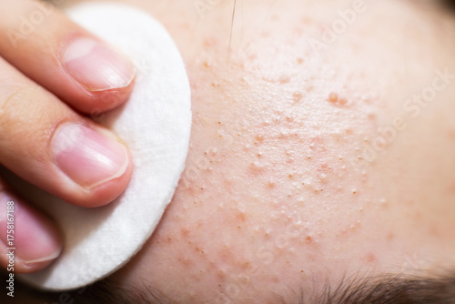 Forehead skin cleansing with cotton pad removing acne