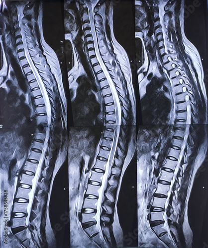 MRI scan of lambo-sacaral spine (LS-spine) : Central and left paracentral extrusion. Nerve root compression with spinal canal stenosis. Medical image concept.