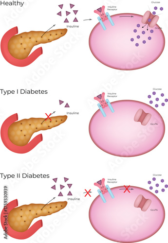 Cellular Mechanisms of Healthy, Type 1, and Type 2 Diabetes Vector Illustration