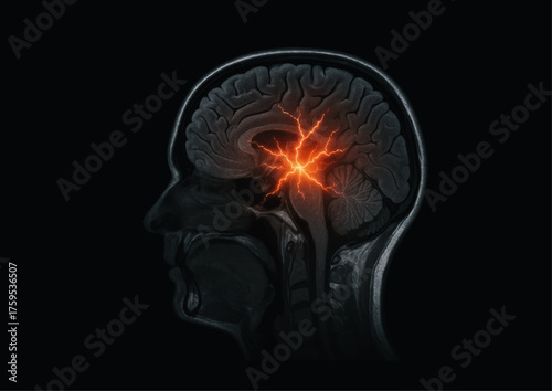 Realistische Darstellung eines epileptischen Anfalls im menschlichen Gehirn – medizinische Visualisierung neuronaler Aktivität während eines Krampfanfalls