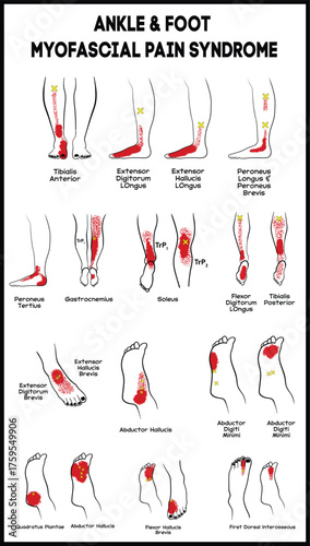 Ankle and Foot Trigger Points - Myofascial Pain Syndrome