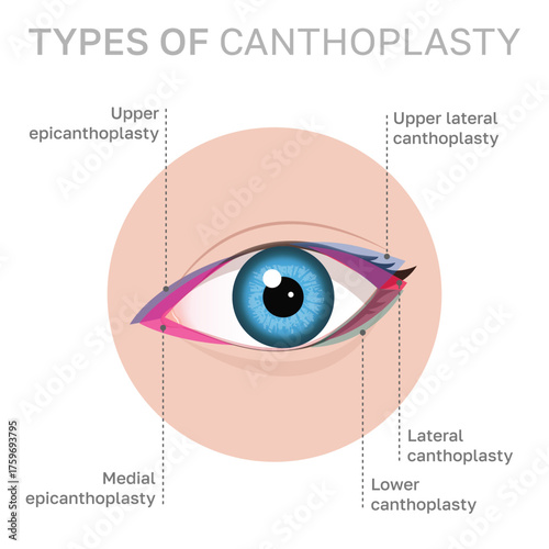 Eye Surgery Techniques: Exploring the Different Types of Canthoplasty. Illustration can be used for beauty and medical content.