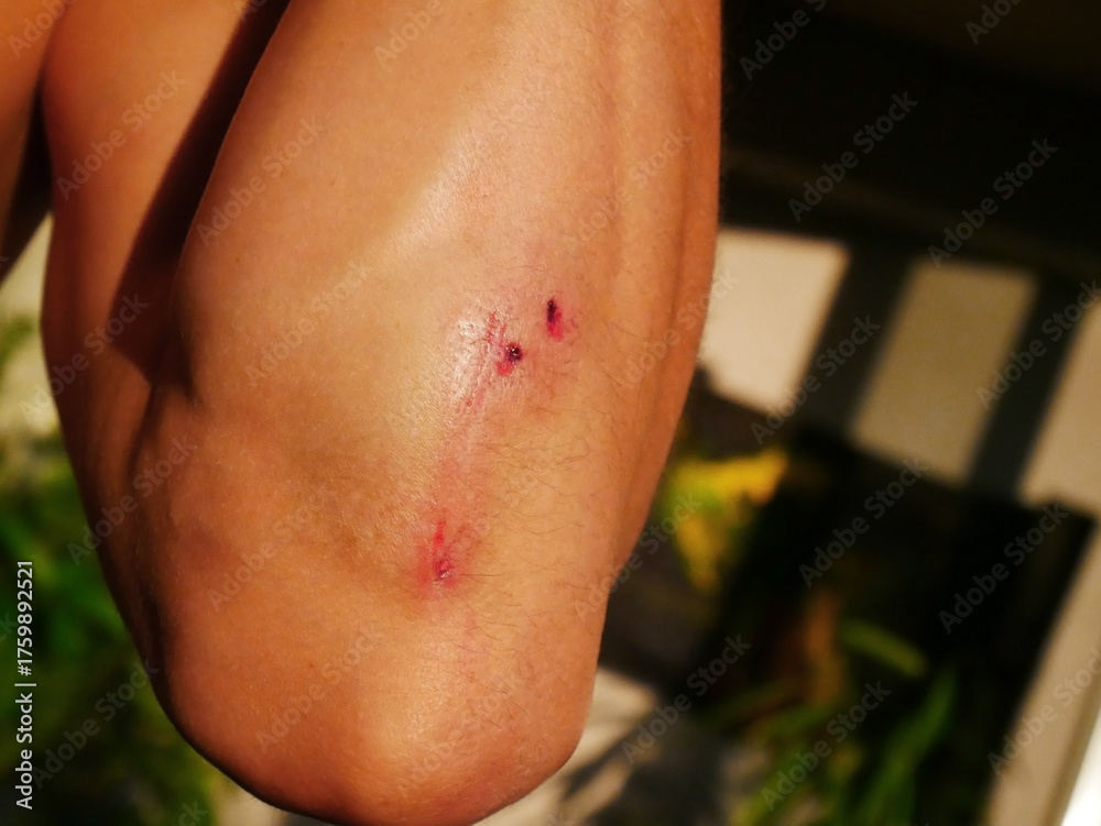 Fototapeta premium Injured man Elbow with Scrapes Against Blurred Background