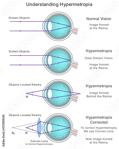 Labeled Diagram Explaining Eye Defect Hypermetropia and Its Image Formation