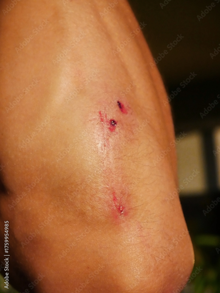 Fototapeta premium Injured man Elbow with Scrapes Against Blurred Background