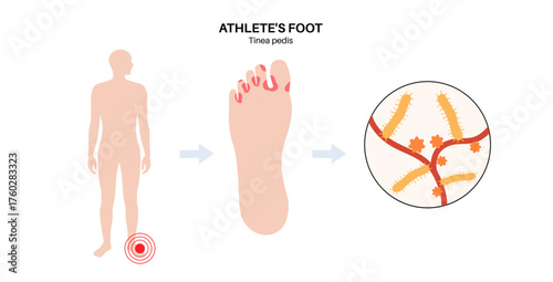 Athletes foot inflammation
