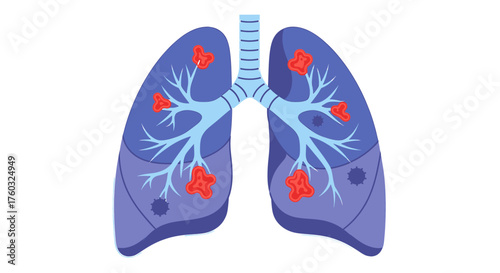 Vector illustration of diseased human lungs with cancerous tumors, representing pulmonary illness or respiratory disease