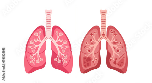 Illustrative Comparison of Healthy Lungs vs