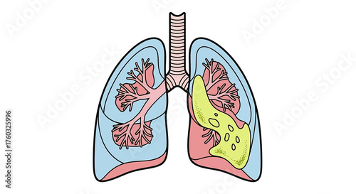 Medical illustration of human lungs with one lung affected by disease, a tumor, or cancer, isolated on a white background.