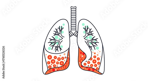 Illustration of human lungs showing inflammation and fluid buildup in the lower lobes.