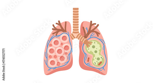 Illustration of human lungs showing alveoli and a cross-section of a diseased lung with inflammation and infection.
