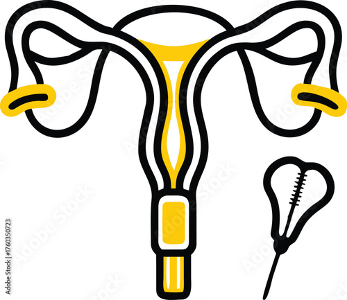 Stylized illustration of female reproductive system and I U D uterus fallopian tubes
