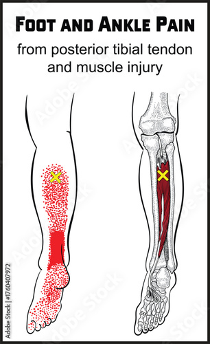 Posterior Tibialis Muscle Trigger Point and Referred Pain Pattern