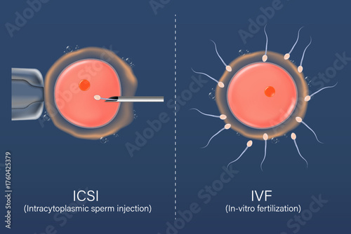 In Vitro Fertilization-IVF and Intracytoplasmic sperm injection-ICSI. Fertility treatment. Assisted reproductive technology in fertility treatment.