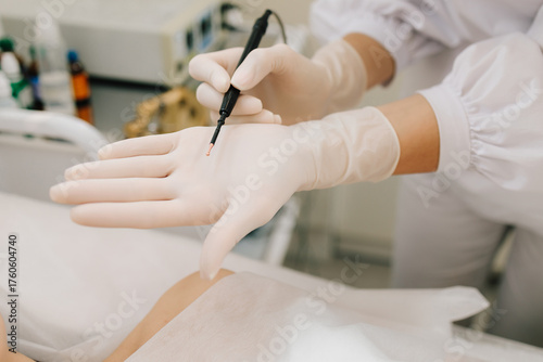 Photography Radiofrequency mole removal under clinical conditions
