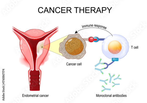 Endometrial cancer therapy.