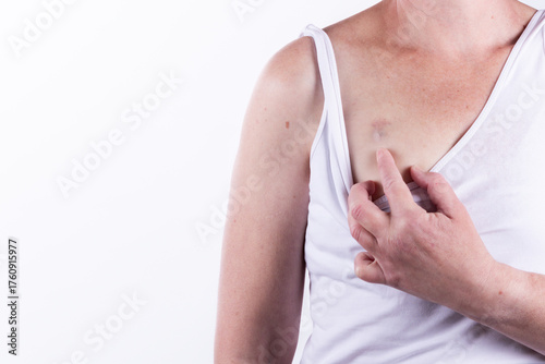 Woman undergoing oncological treatment with a venous port (Port a cath) implanted. It is a metal or plastic reservoir connected to a catheter that is implanted under the skin