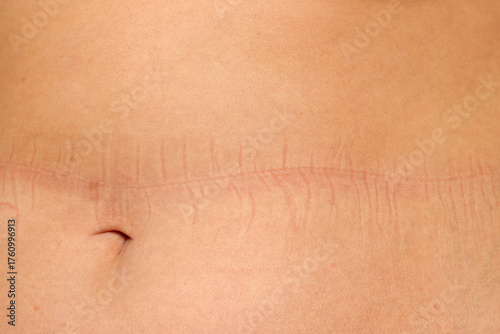 Studio shot of overweight woman stomach with elastic marks from underwear on white background.