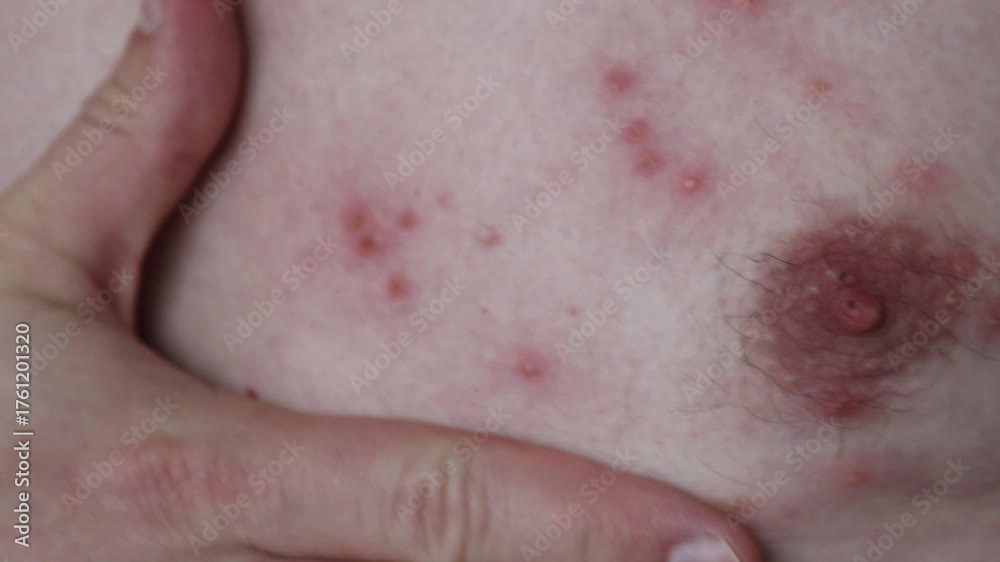 Skin Rash Complete Refrenxe Video Stock Close-up image showing the skin rash and blisters typical ...