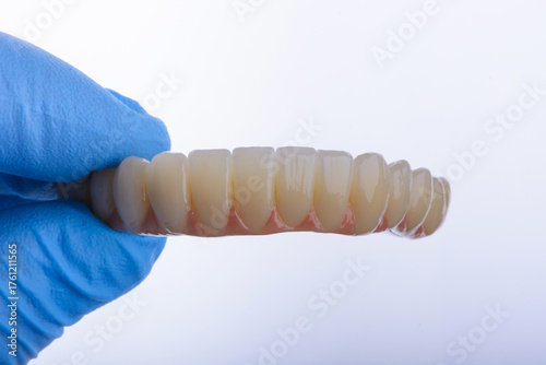 Full dental zirconium prosthesis on titanium bar stained with stains for ceramic.