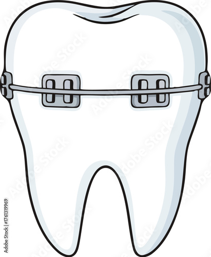 Illustration of a white tooth with metal braces attached to it, showing orthodontic treatment.