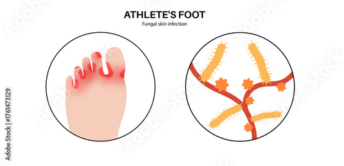 Athletes foot inflammation