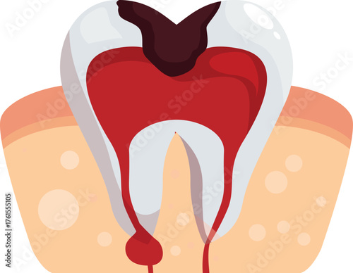 Diseased tooth with caries and gingivitis bleeding and causing periodontitis, requiring urgent dental care