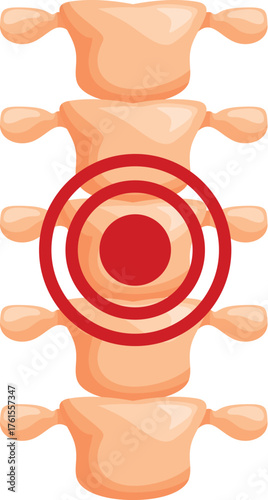 Red circles highlighting painful area of human spine, indicating intervertebral disc herniation