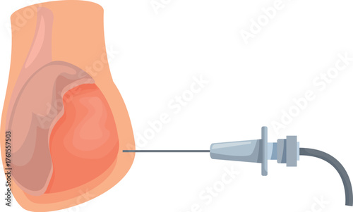 Medical instrument injecting a needle into the prostate gland during a prostate cancer treatment