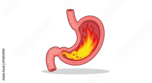 Anatomical Illustration of a Human Stomach with Internal Inflammation and Burning Sensation.
