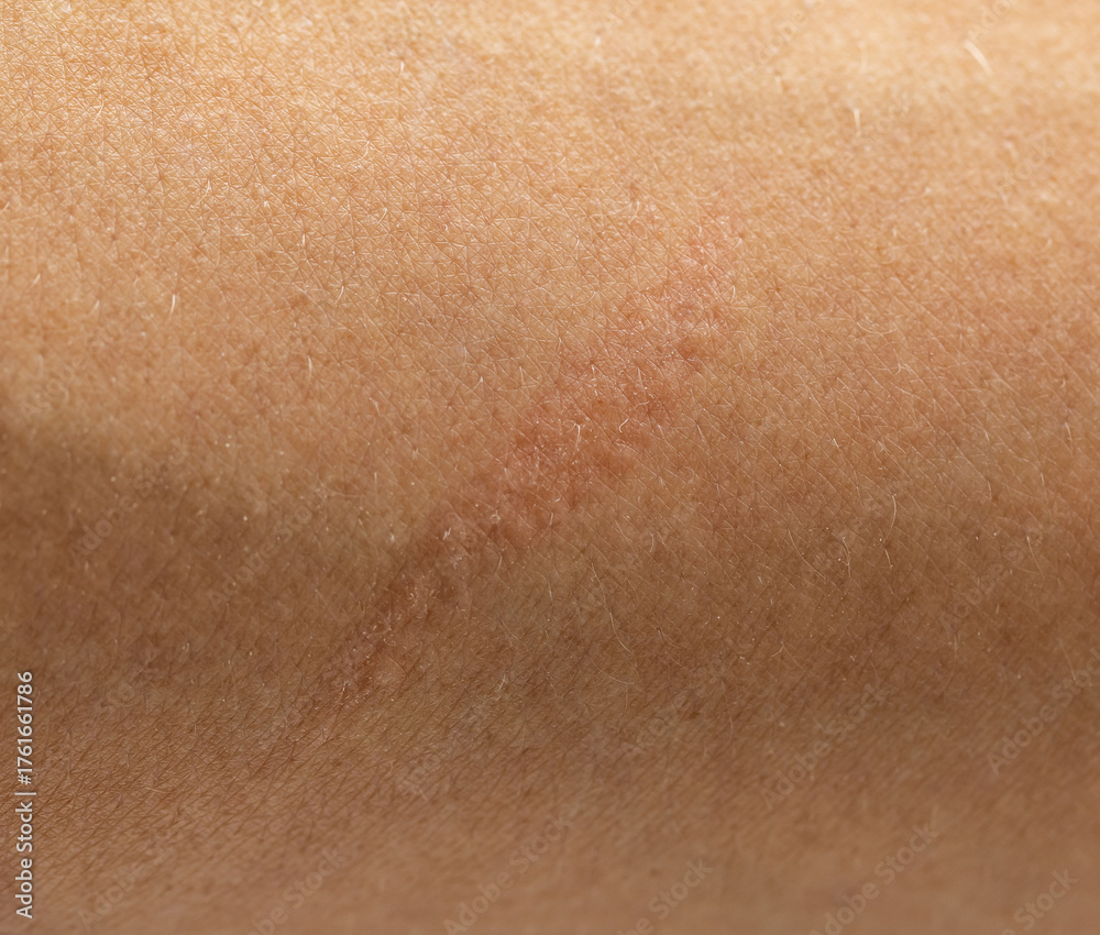Fototapeta premium A person's arm with a scar