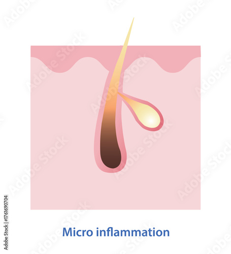 Diagram of micro inflammation within pore vector illustration. Acne cycle caused by small, blocked pores, microcomedones breakdown, inflammation occurs beneath the skin surface. Skin anatomy concept.