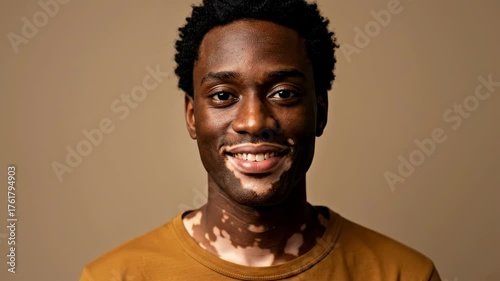 Man with vitiligo smiles, looking at camera. Skin condition and individuality. Diverse representation and self-acceptance.