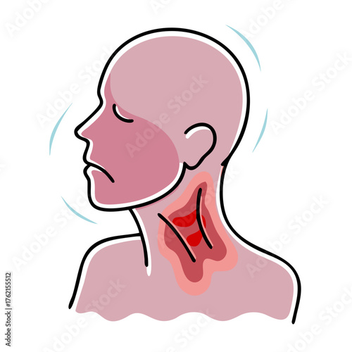 An illustration of a person with a severe sore throat and inflamed neck, indicating discomfort and illness. Ideal for blogs on health, medical symptoms, or pain relief.