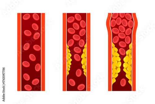 Illustration normal blood vessels vs arteries with cholesterol plaque.