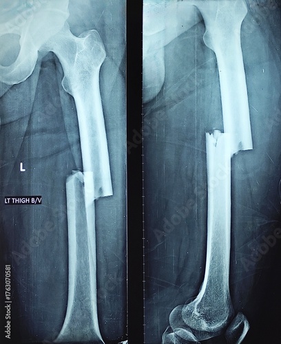 Left femoral-shaft fracture — displaced, comminuted segmental fracture; AP and lateral radiograph, shaft of femur fracture 