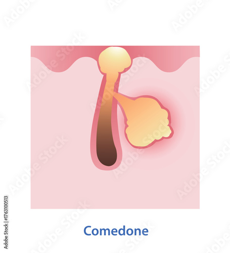 Diagram of comedone on skin surface vector illustration. Excess oil production in sebaceous glands become clogged in pore, can lead to comedone, blackheads, whiteheads and acne. Skin anatomy concept.