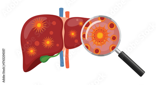 Medical illustration of a diseased human liver with cancer cells.